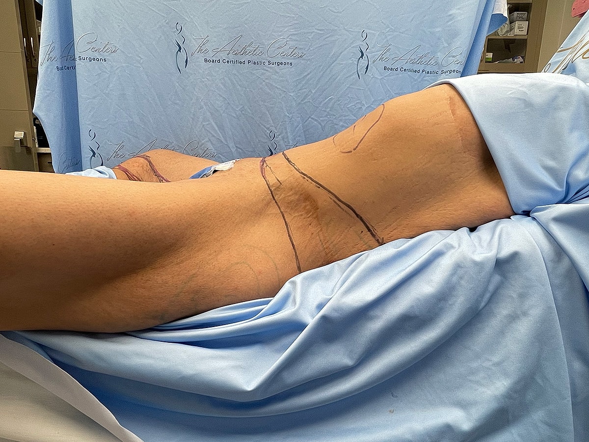 Patient preparing for body contouring procedure.