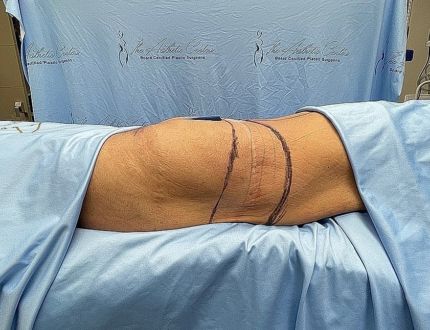 Surgery preparation in a medical setting.
