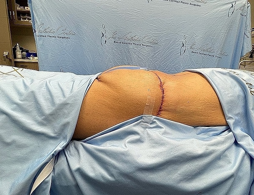 Surgical procedure with visible incision and drapes.