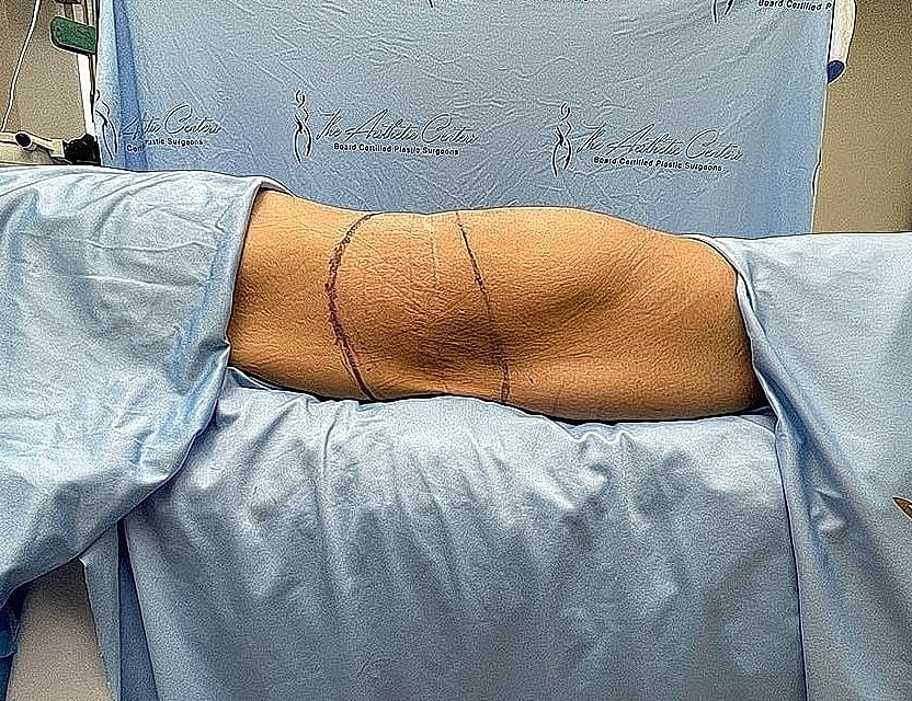 Patient preparing for surgical procedure in hospital.