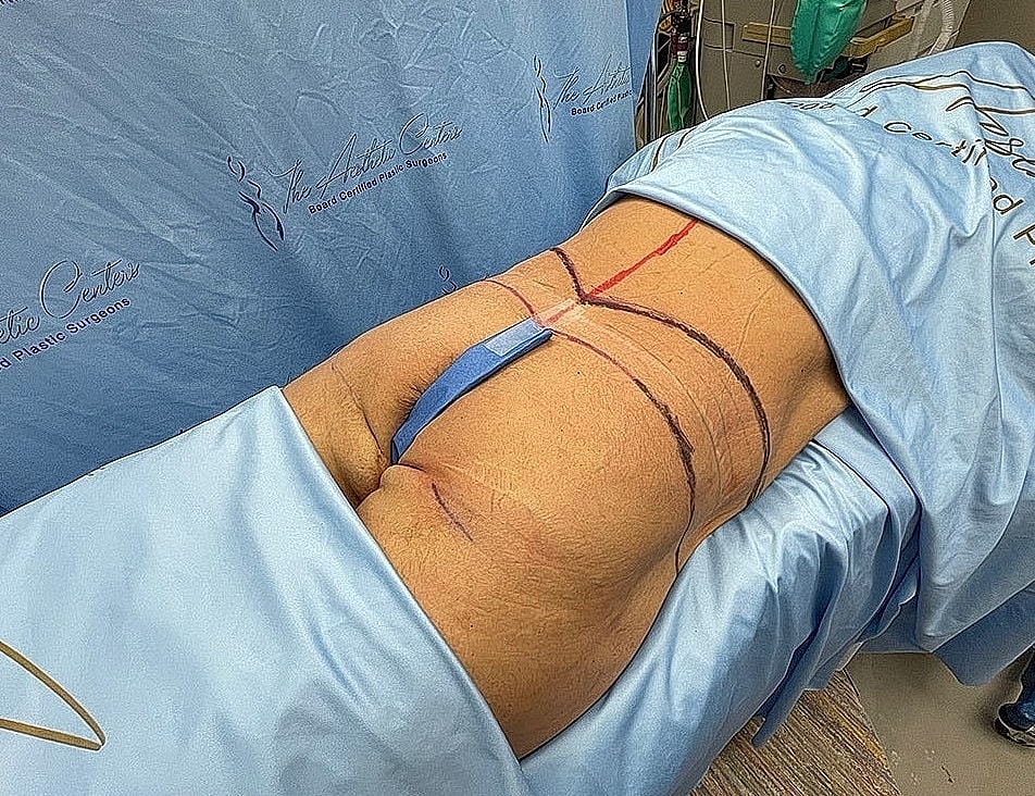 Patient prepped for plastic surgery procedure.