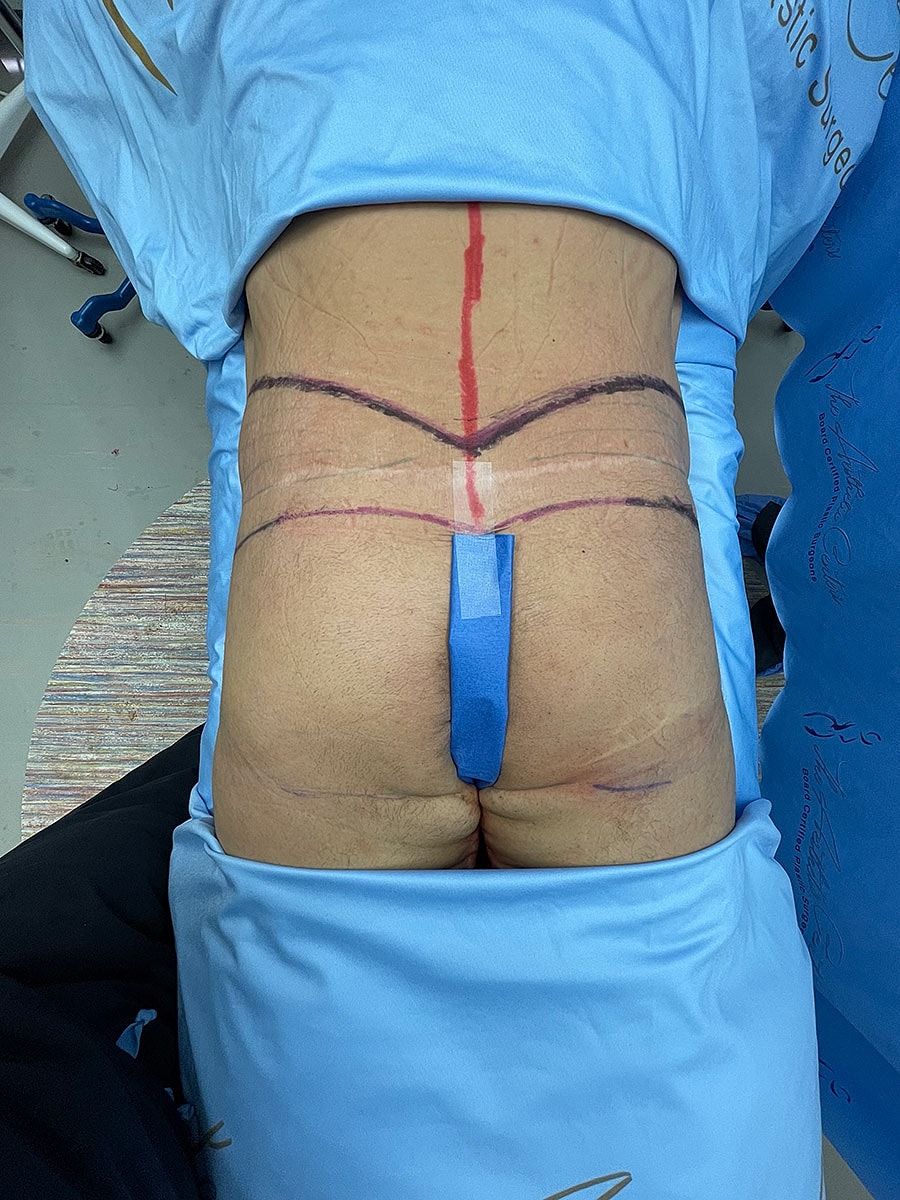 Surgical markings on a patient's lower back.