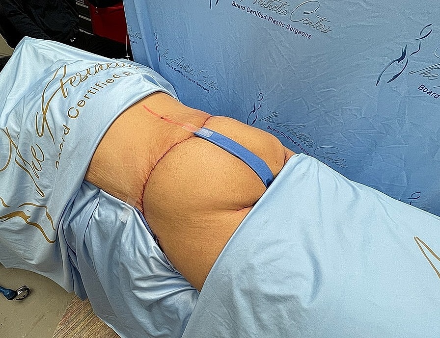 Patient undergoing a surgical procedure in recovery.