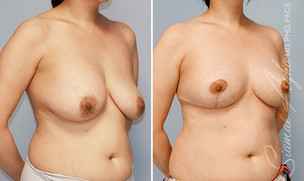 Before and after breast enhancement photo comparison.