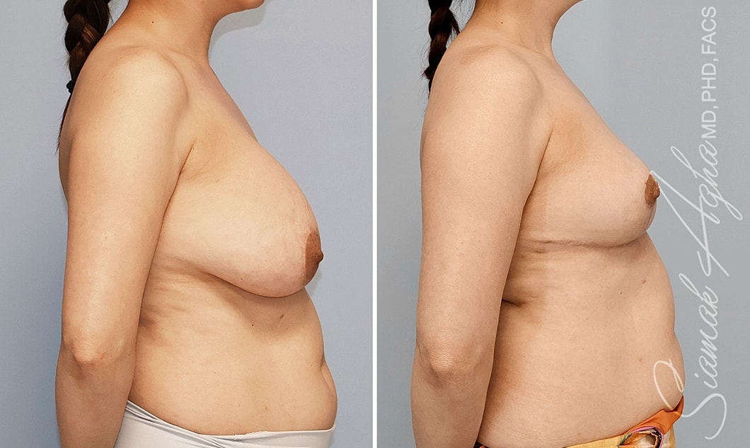 Before and after body transformation comparison image.