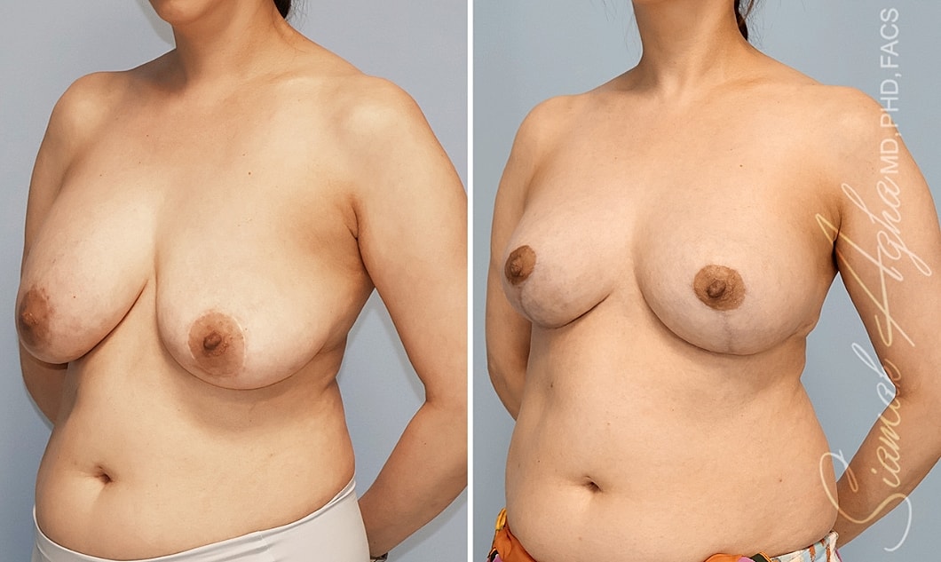 Breast augmentation before and after comparison.