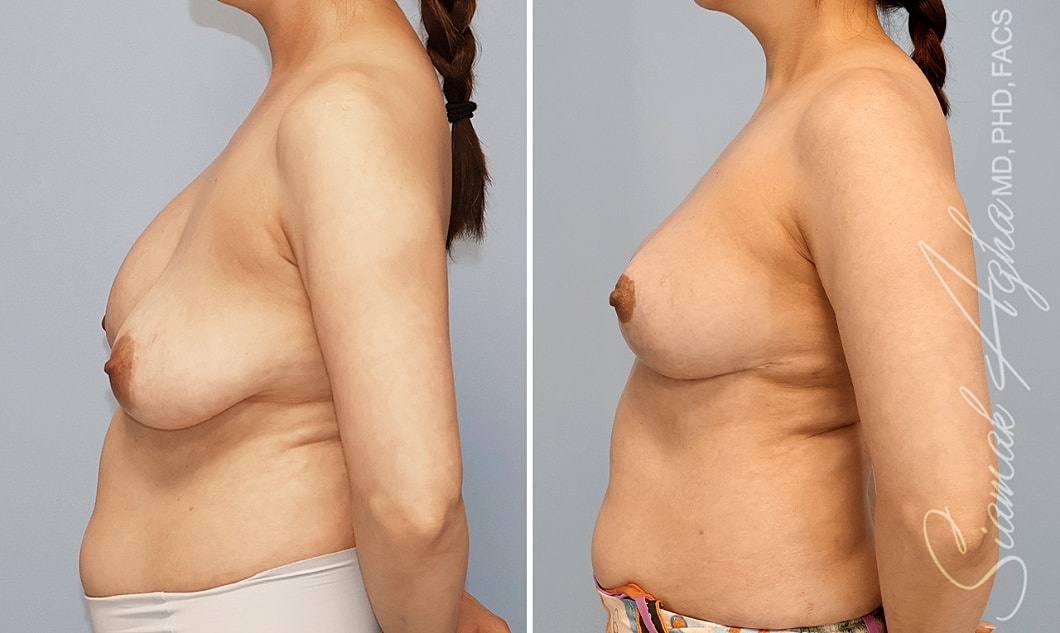 Before and after body contouring comparison.