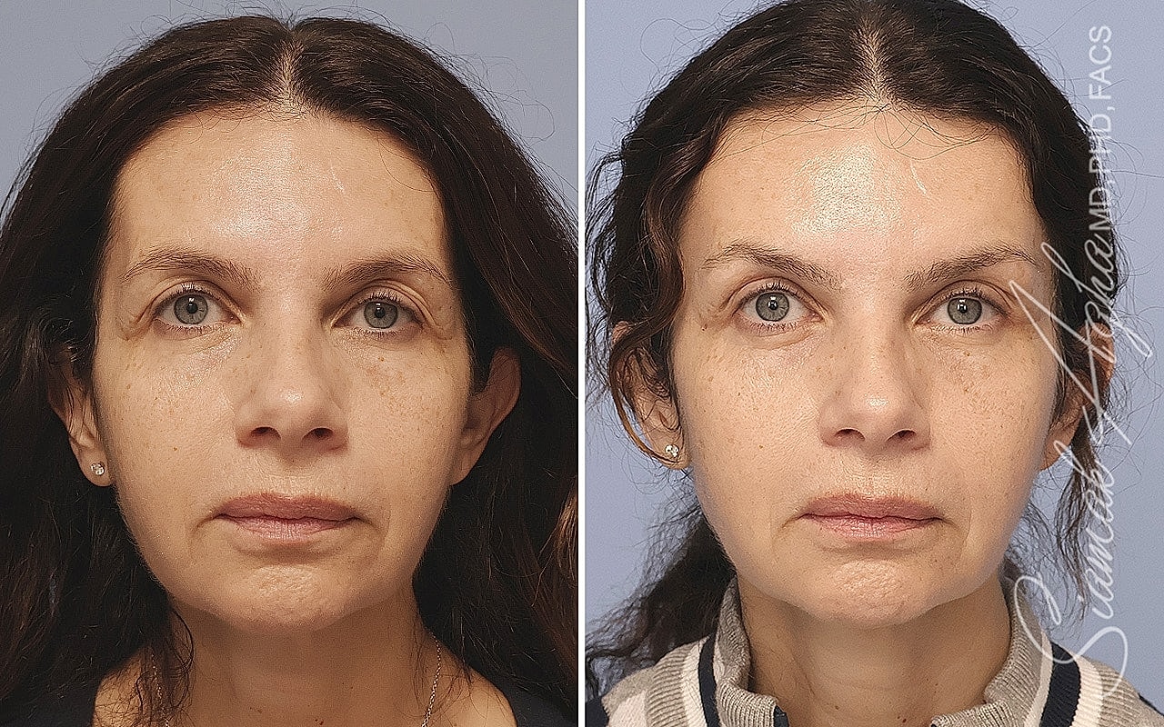 Facial transformations before and after treatment.