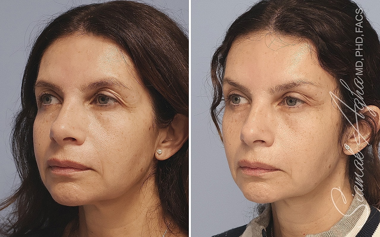 Before and after cosmetic treatment comparison.