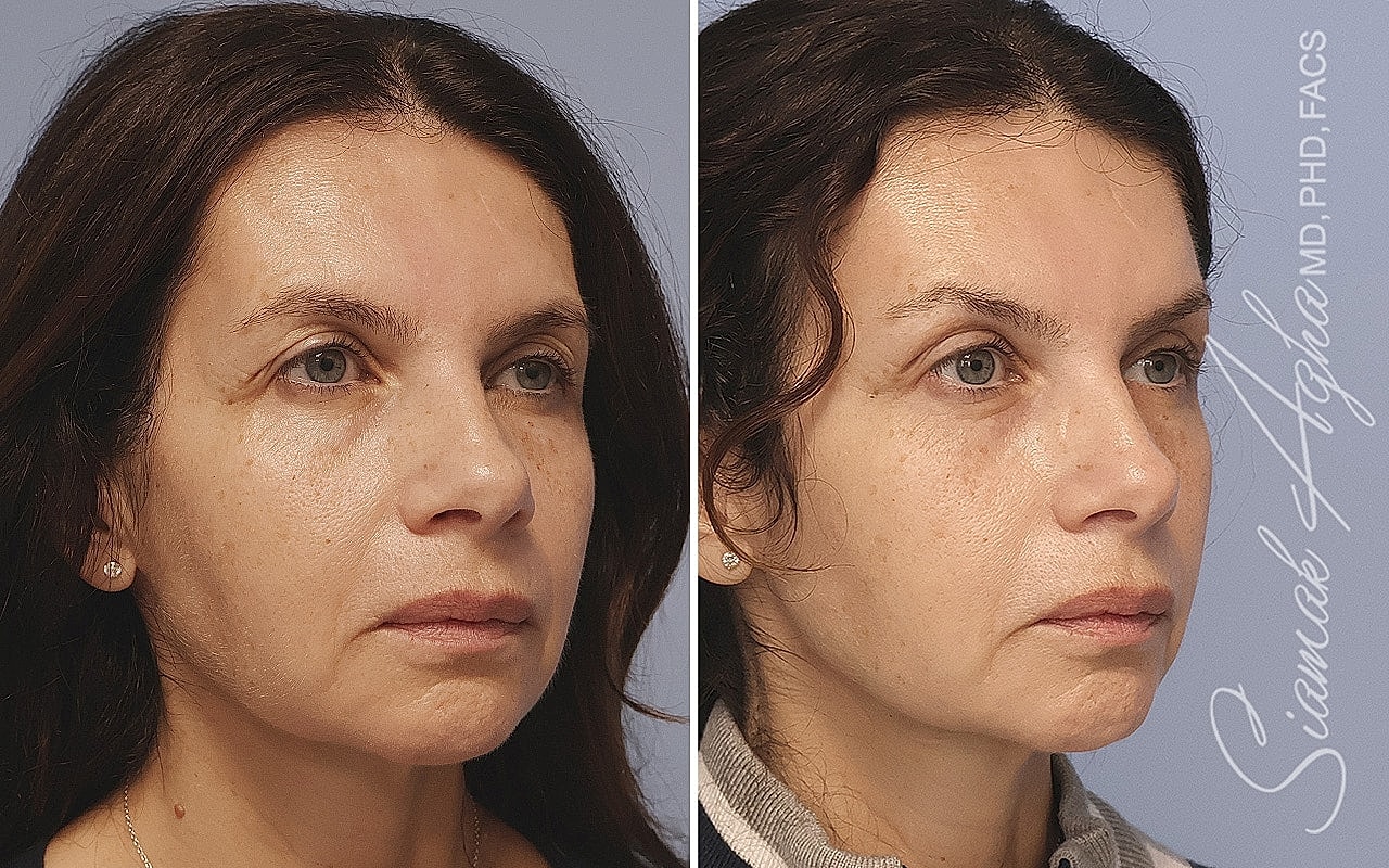 Before and after facial rejuvenation treatment comparison.