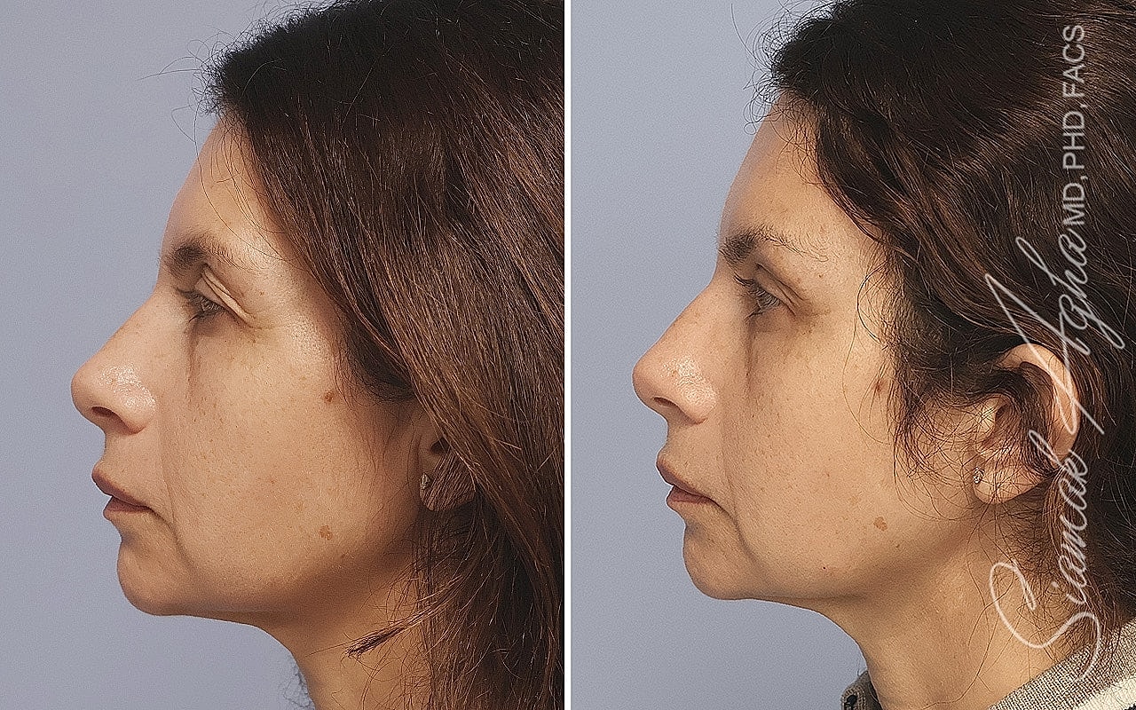 Before and after profile comparison of a woman.