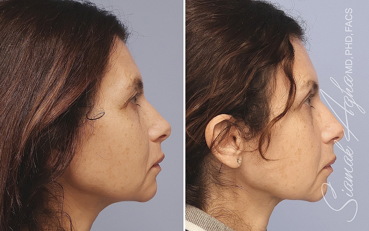 Before and after side profile comparison of woman.