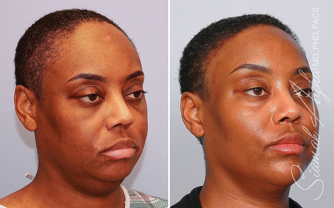 Before and after cosmetic procedure comparison image.
