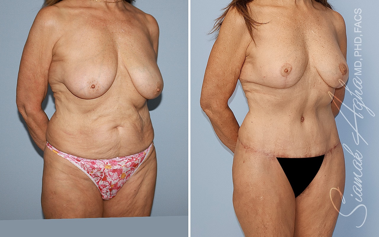 Before and after body transformation comparison image.