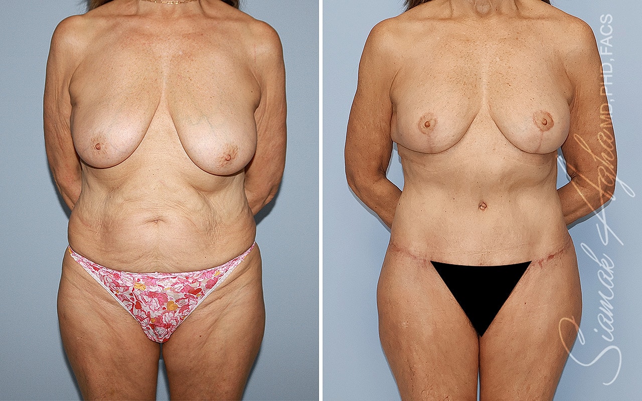 Before and after body transformation comparison.