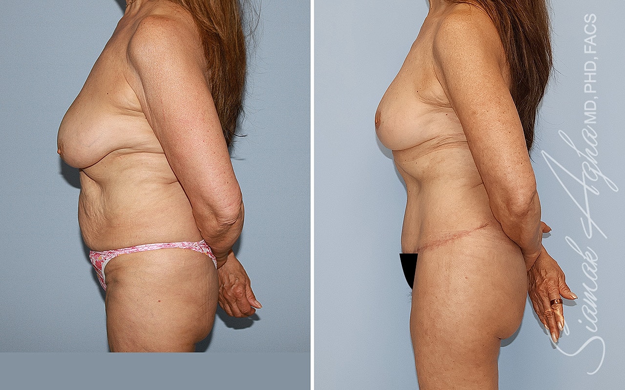 Before and after body transformation photos.