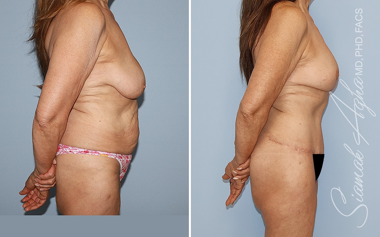 Before and after body contouring surgery comparison.