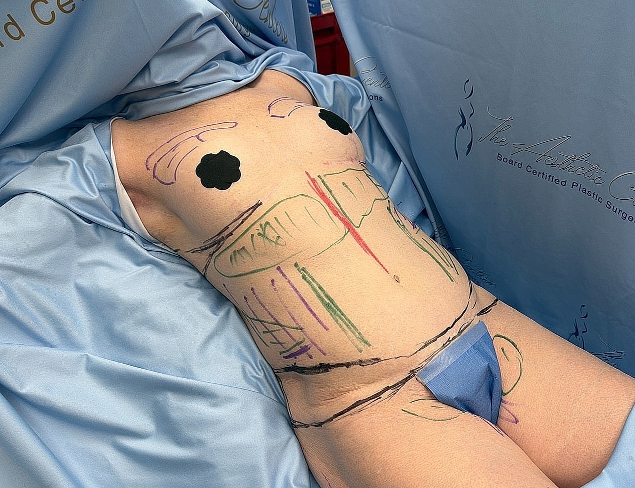 Body marked for surgery preparation.