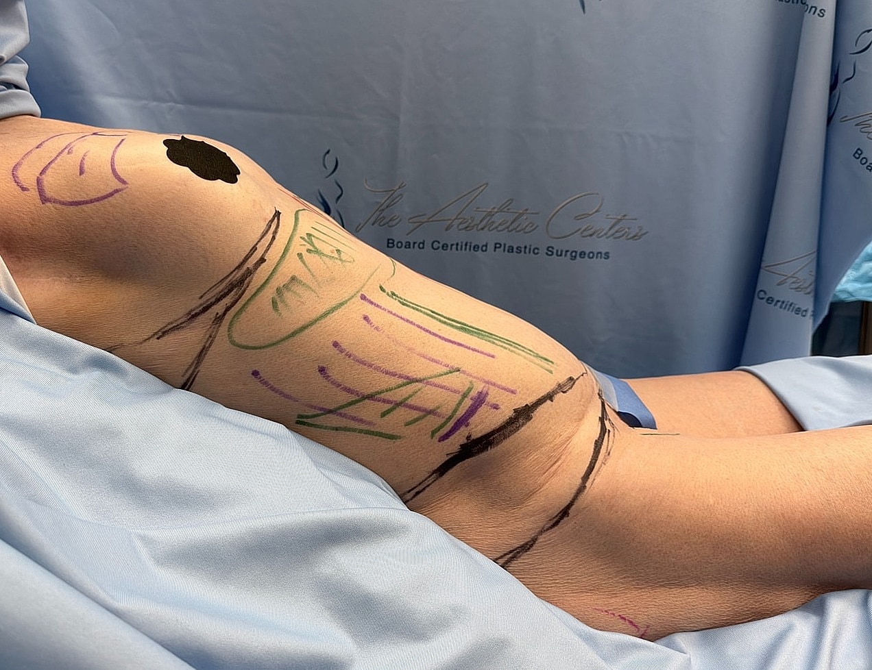 Patient markings before cosmetic surgery procedure.