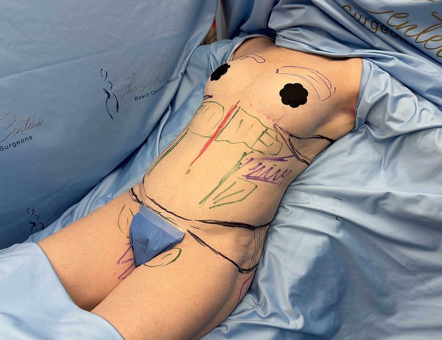 Body with markings for surgical procedure preparation.