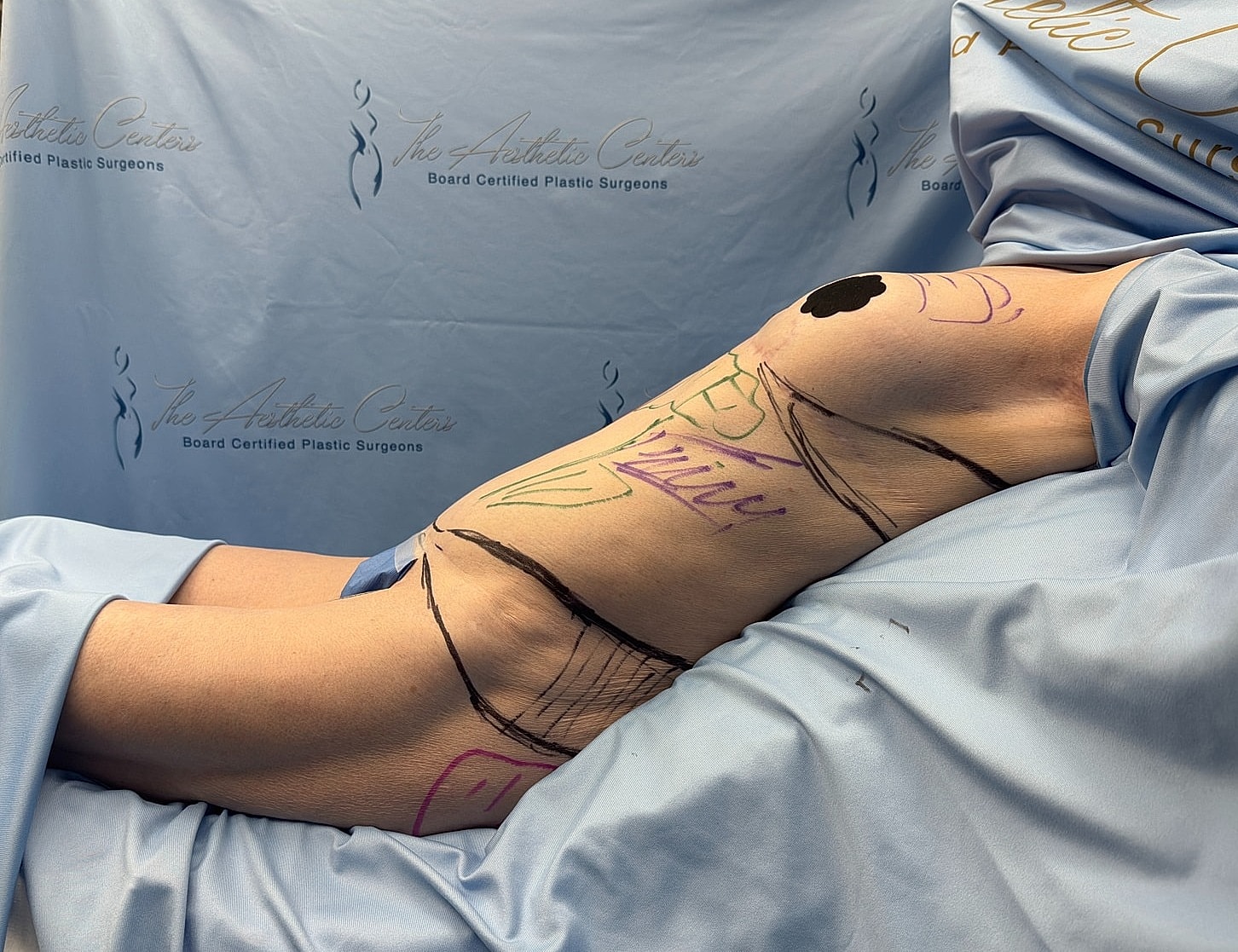 Arm with sketches for surgical markings.