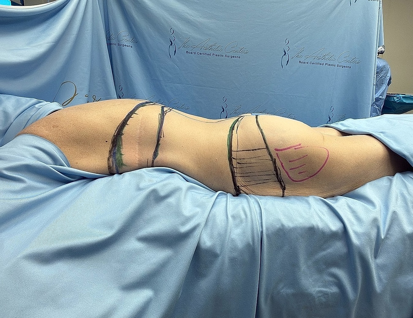 Patient marked for surgical procedure in operating room.