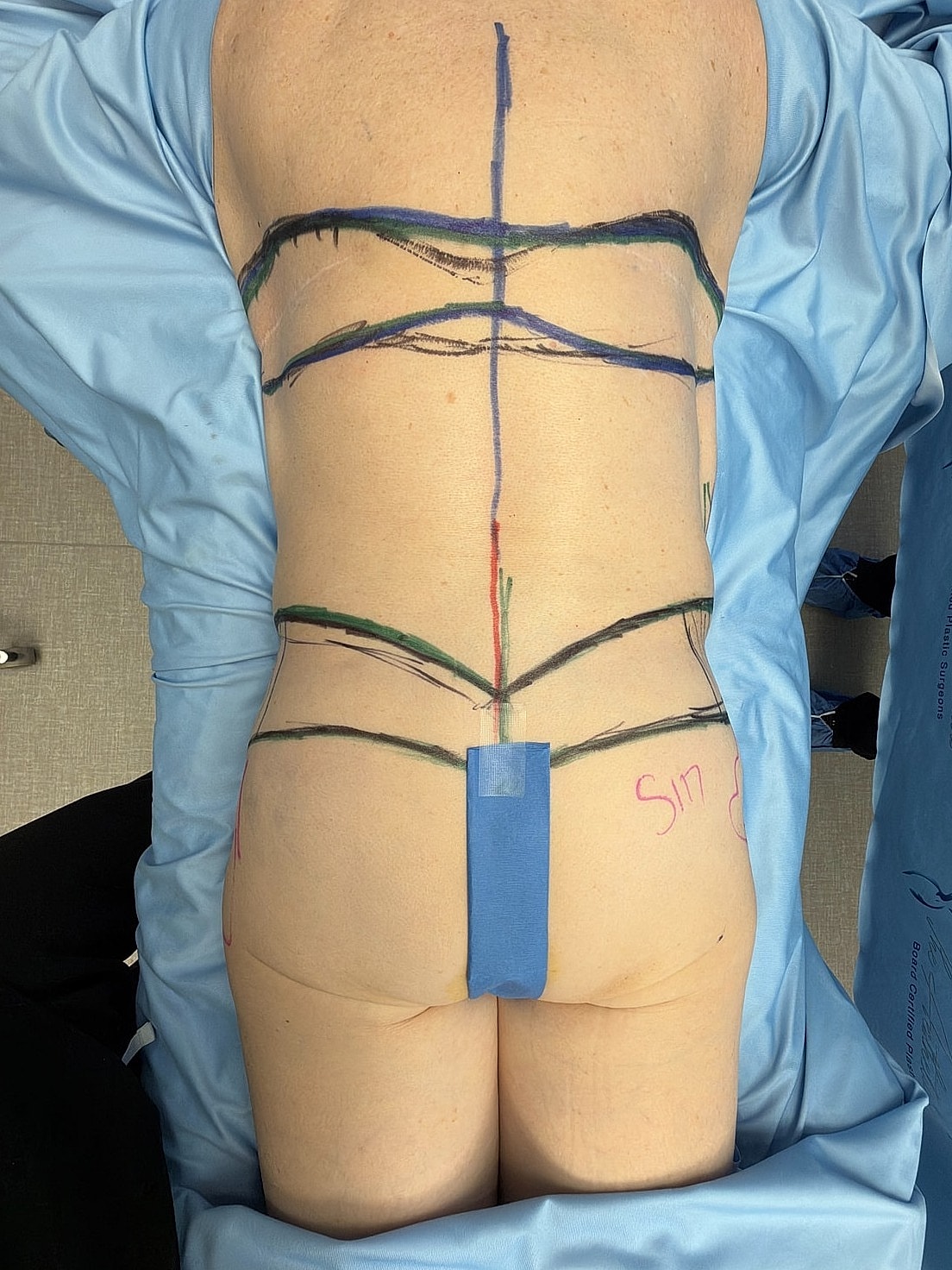 Marked back with colored lines for surgery preparation