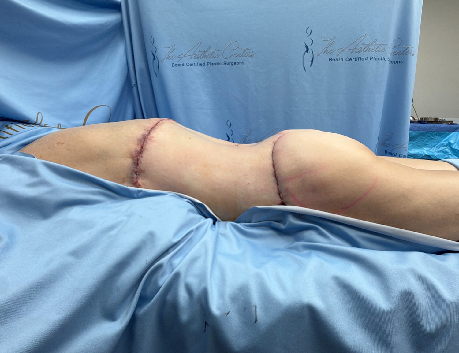 Post-surgical view of body contouring procedure.