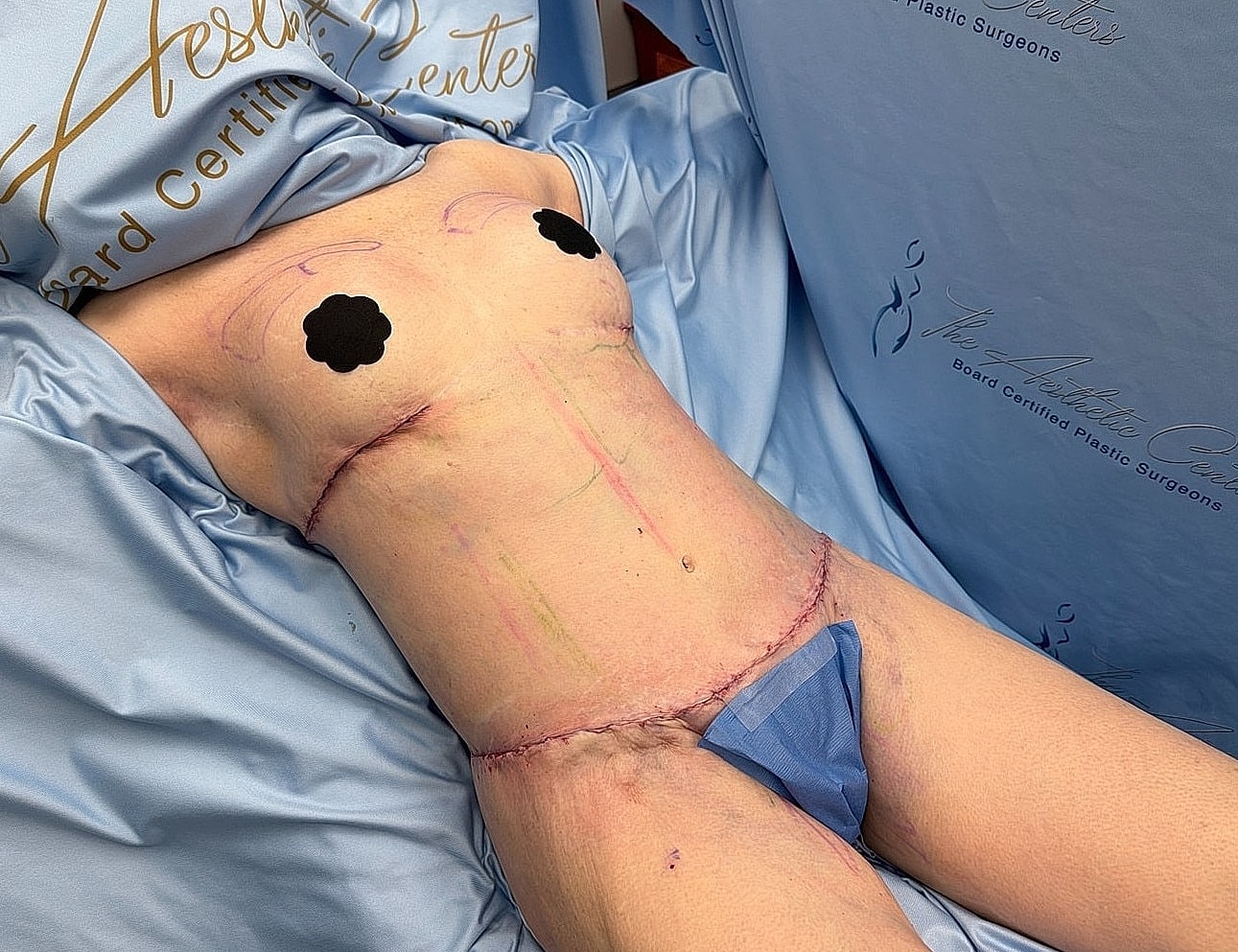 Post-surgery patient preparation in medical setting.