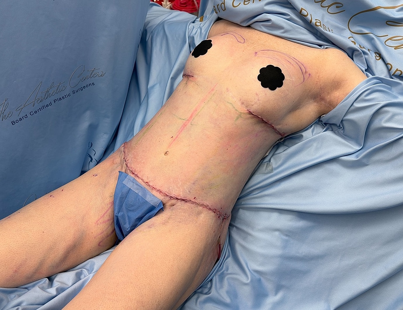 Post-surgery patient on an operating table.