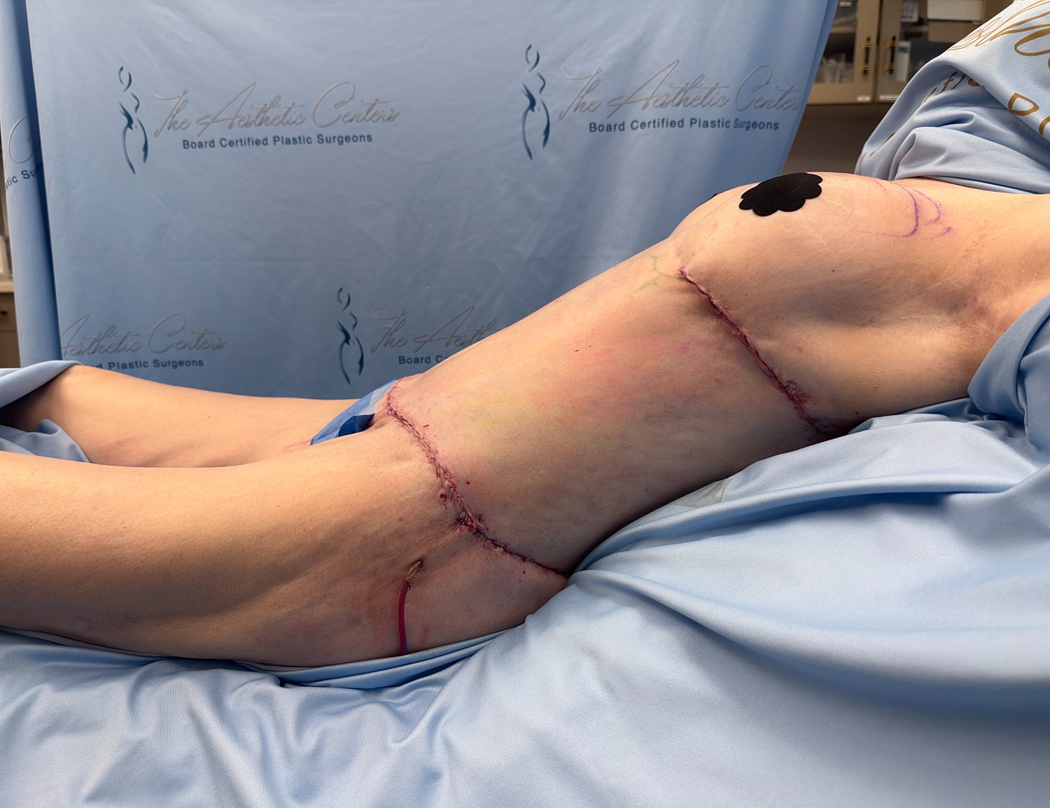 Surgical scars on patient's leg after procedure.