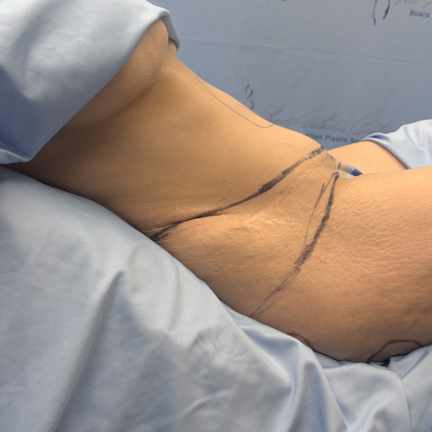 Surgical markings on a patient's side.