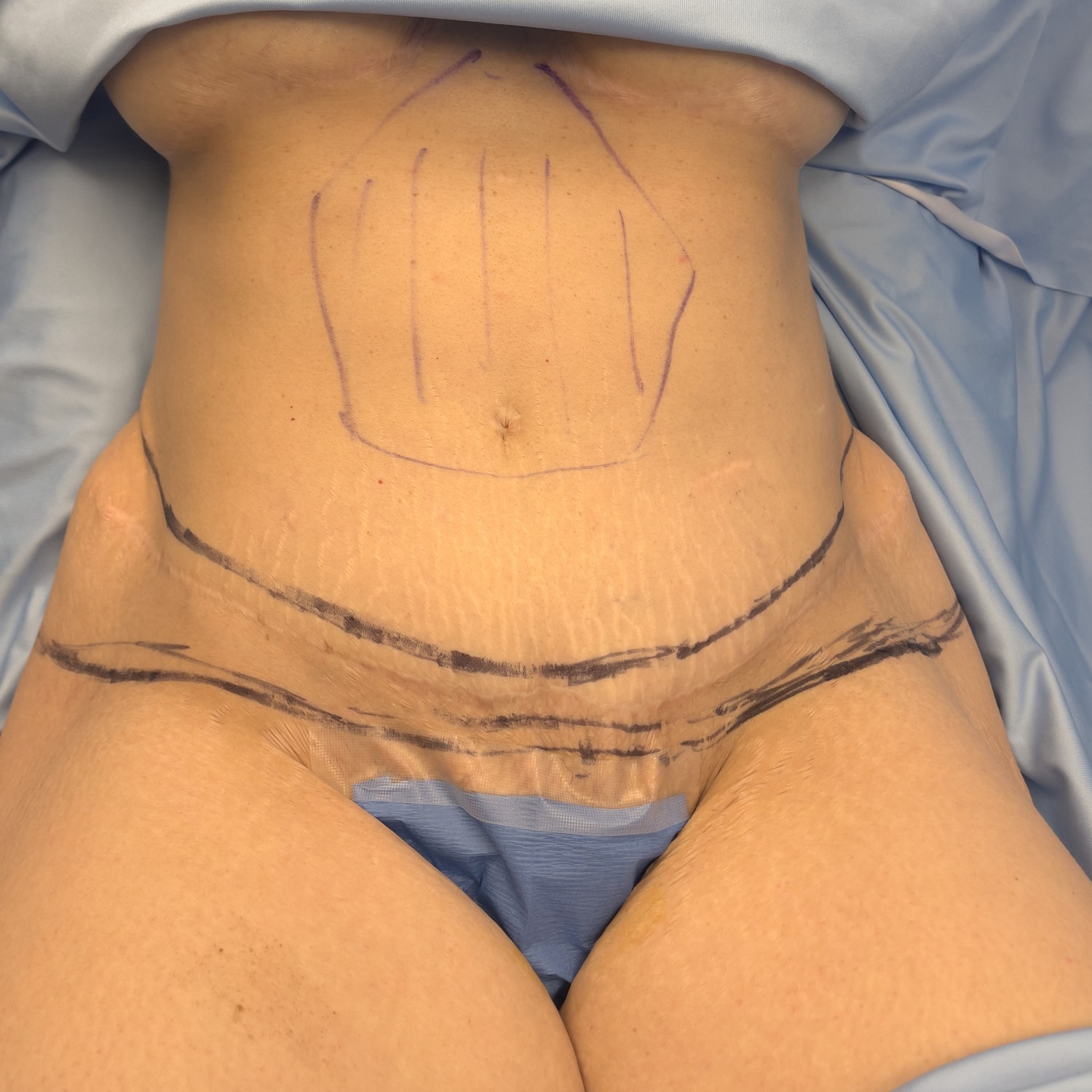 Marked abdomen preparing for surgical procedure.