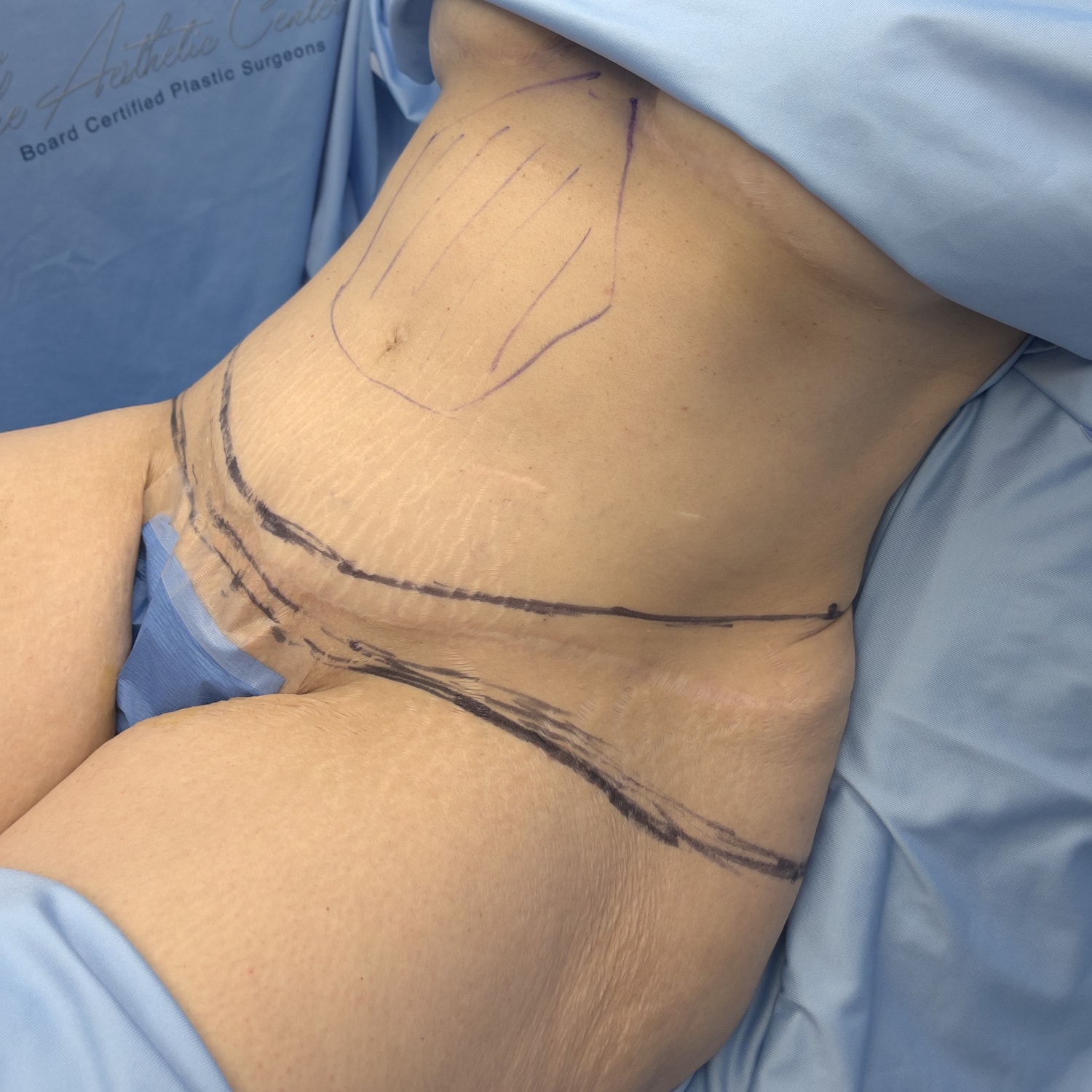 Marked abdomen preparing for surgery.