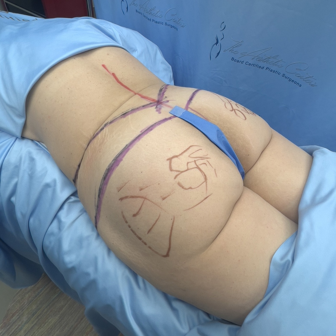 Patient preparing for cosmetic surgery procedure.