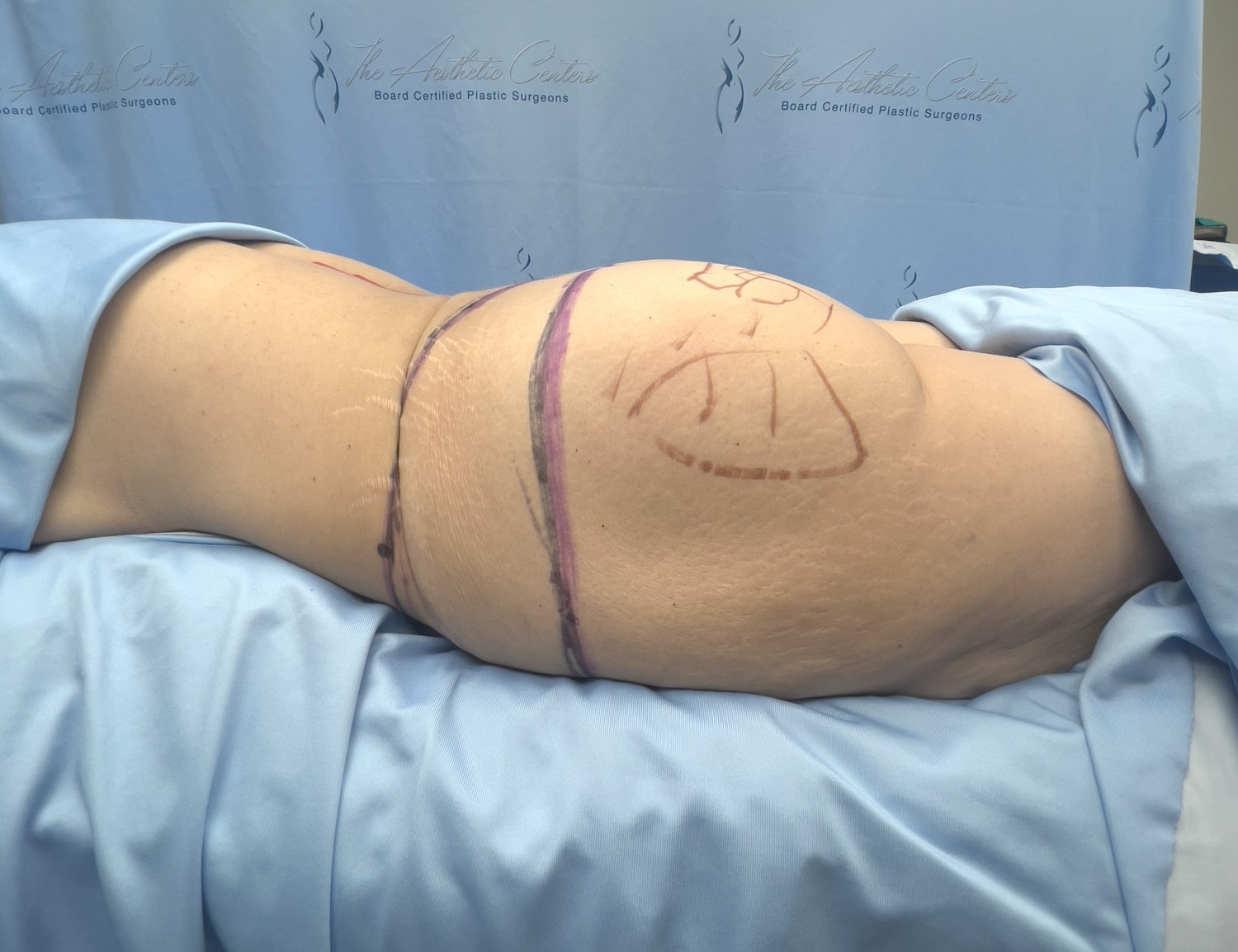 Body contouring markings on patient in surgical setting.