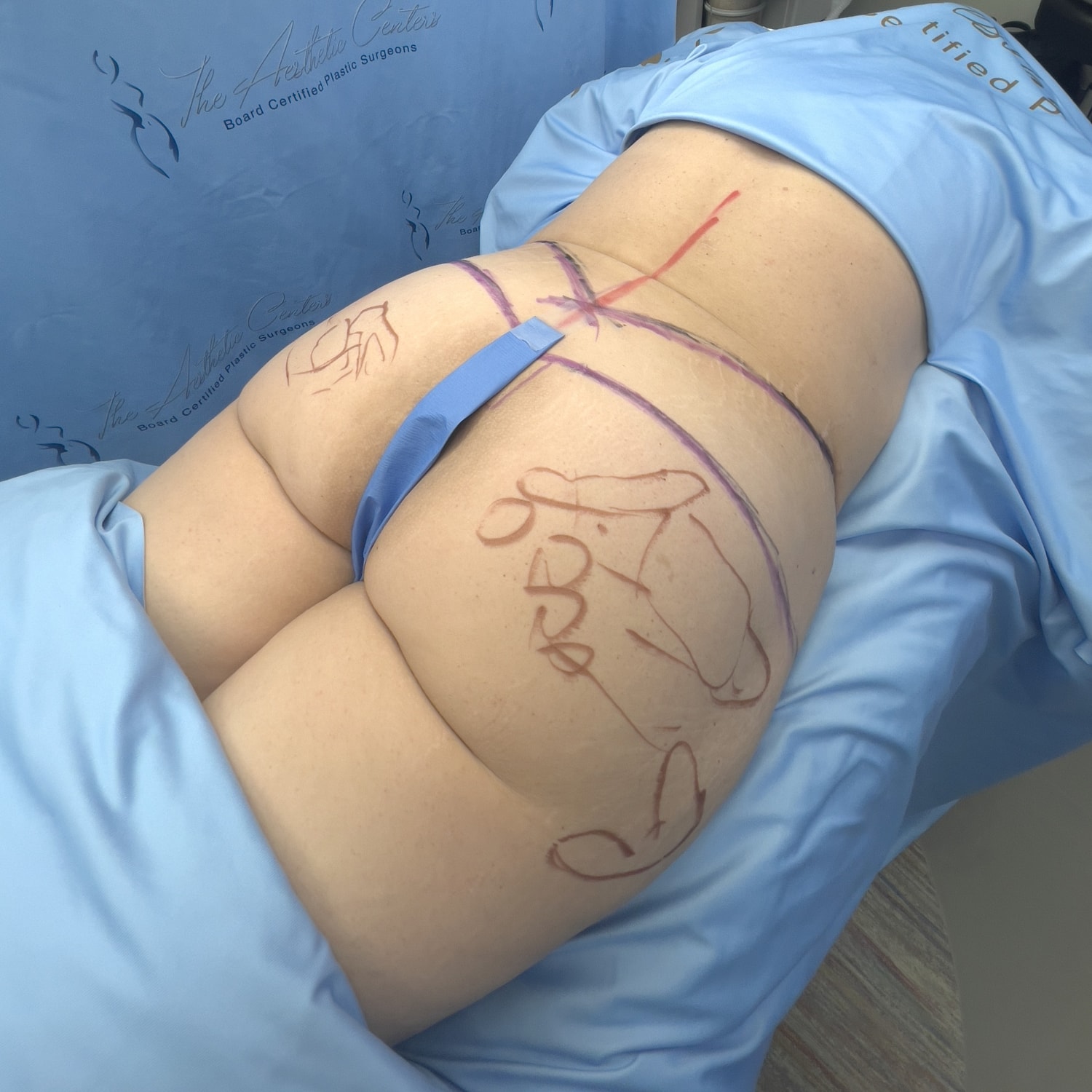 Pre-surgery markings on patient's backside.