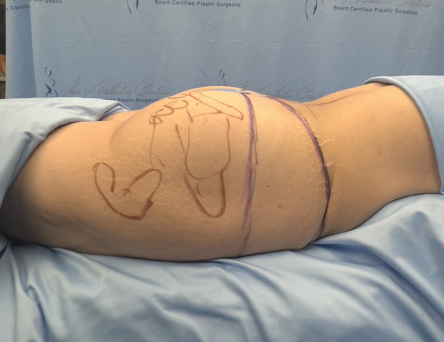 Body contouring markings on patient's side.