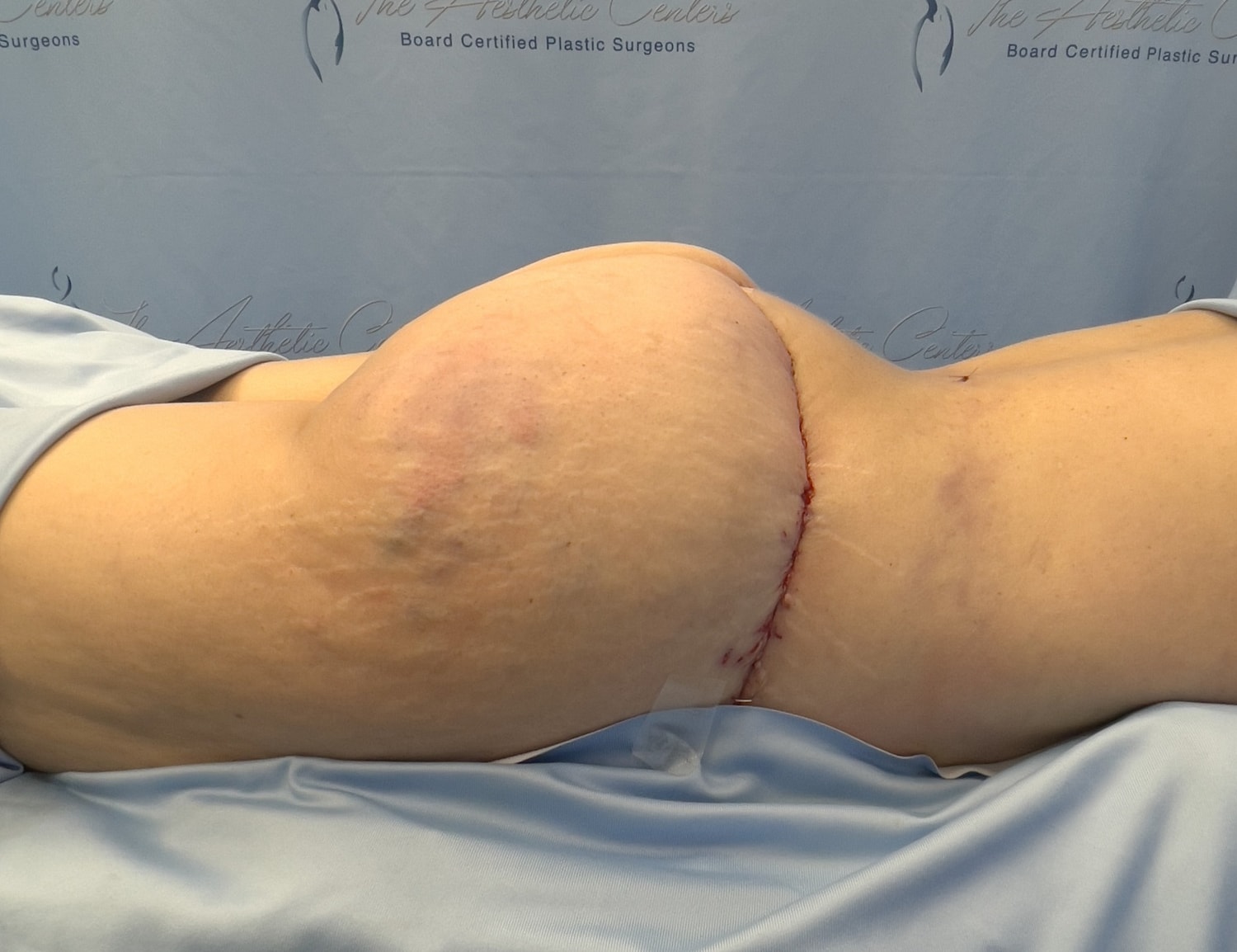 Post-surgery patient abdomen with visible incision.