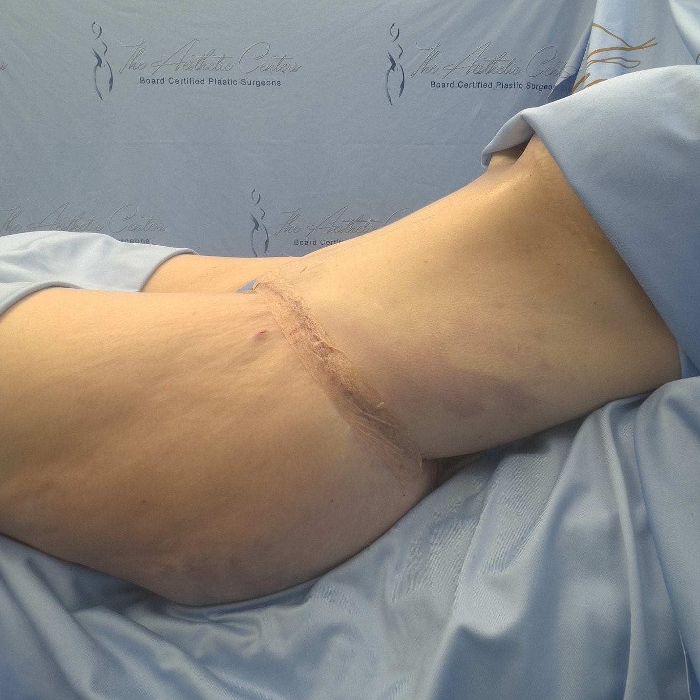 Post-surgical recovery of a patient's thigh area.