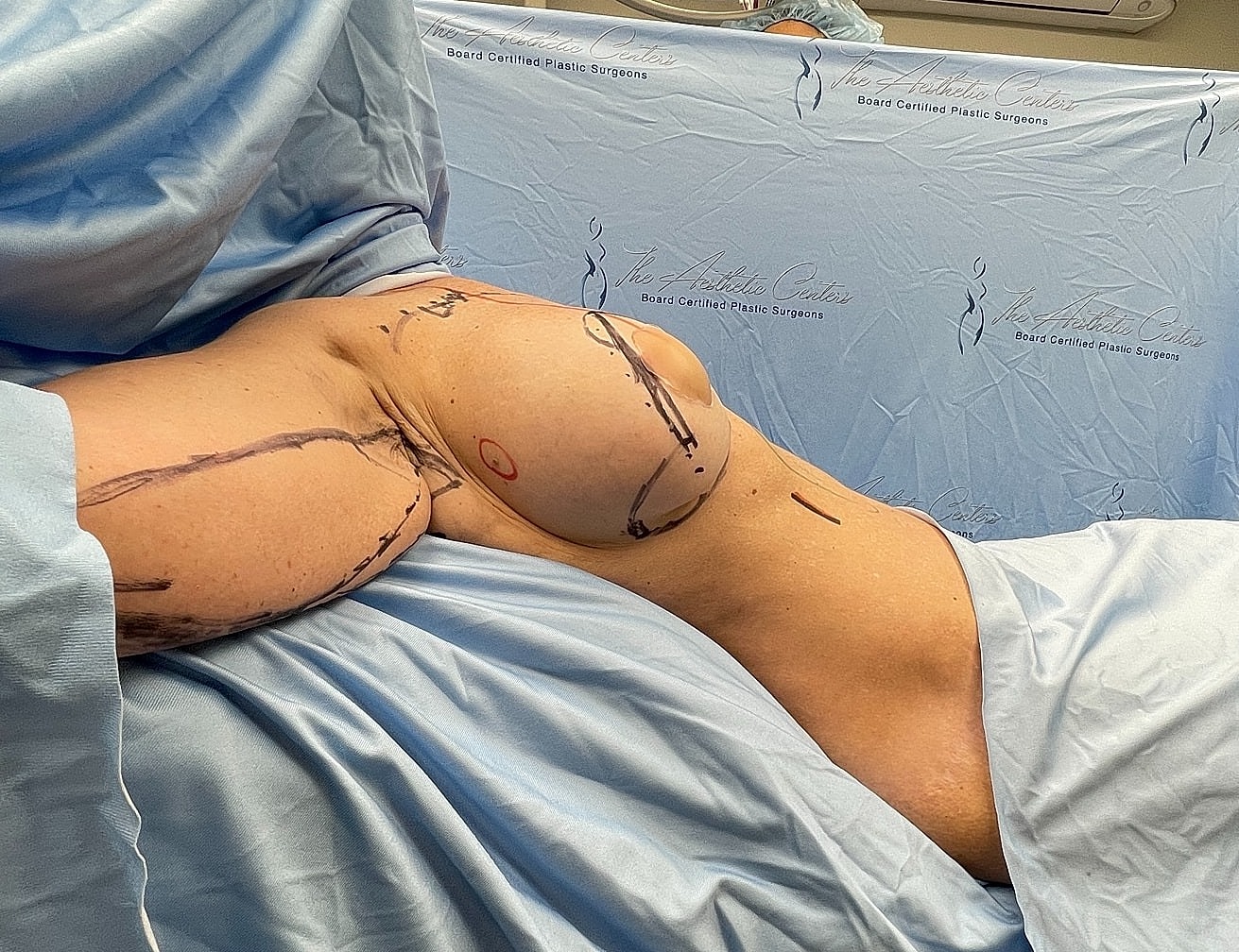 Patient preparing for breast augmentation surgery.