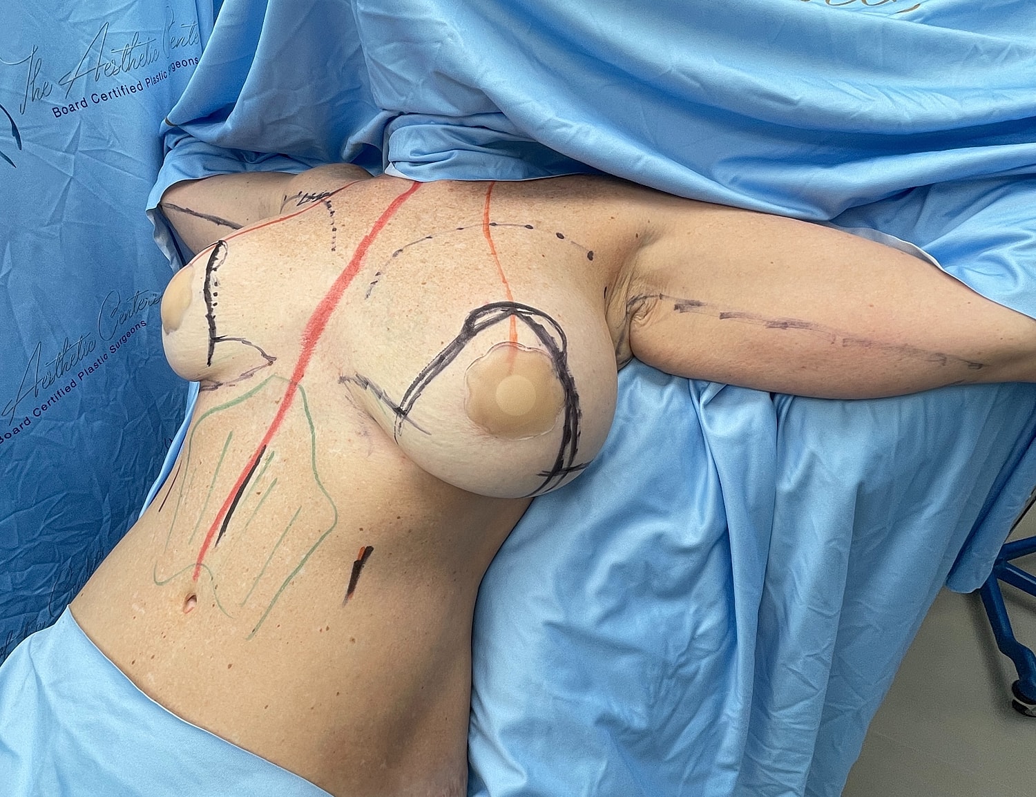 Surgical markings on a body for procedure preparation.