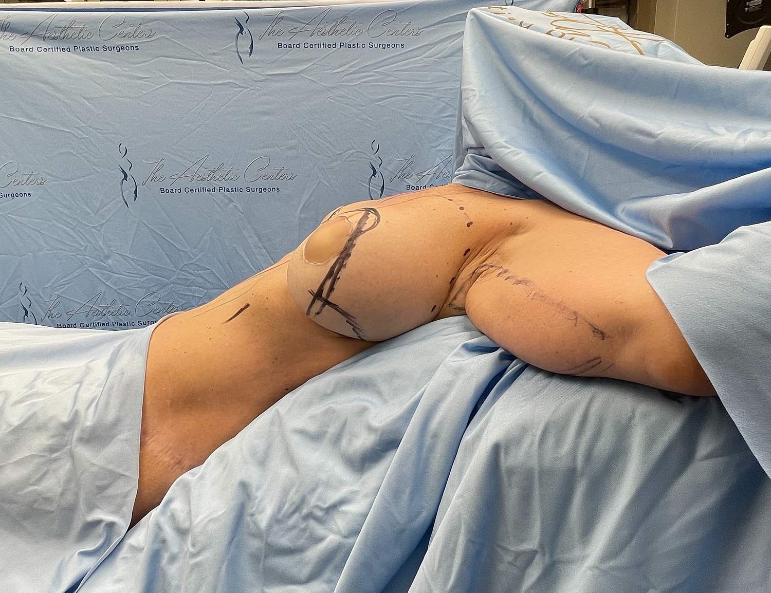 Surgical procedure preparation in medical setting.