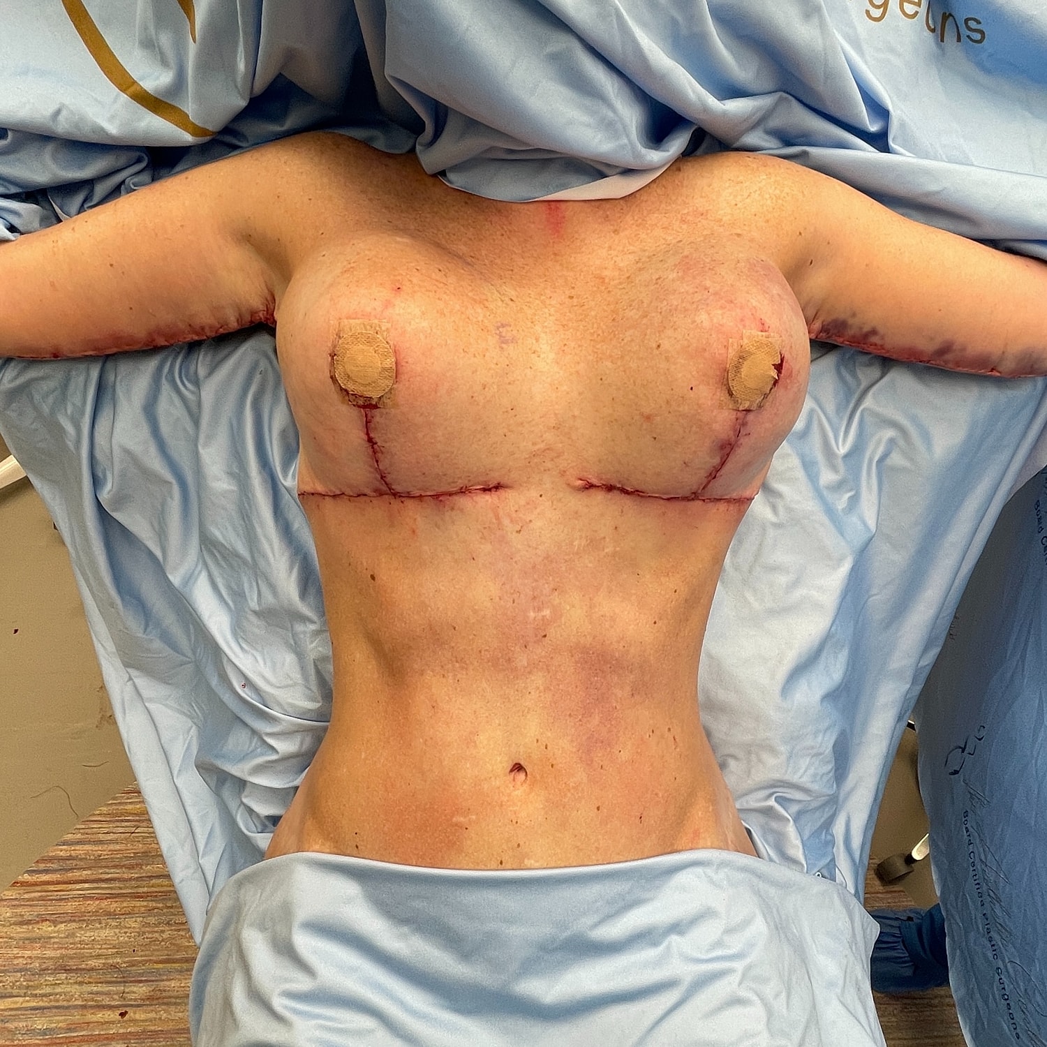 Post-surgery chest with visible stitches and bandages.