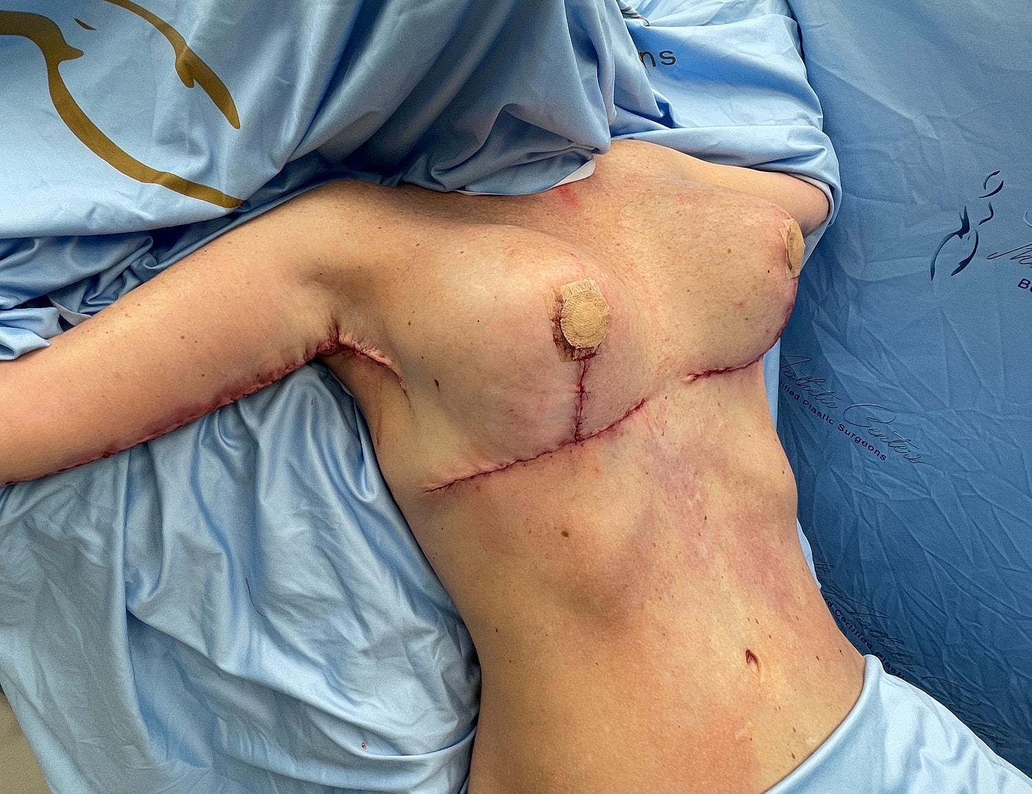 Post-surgery patient with visible stitches on torso.