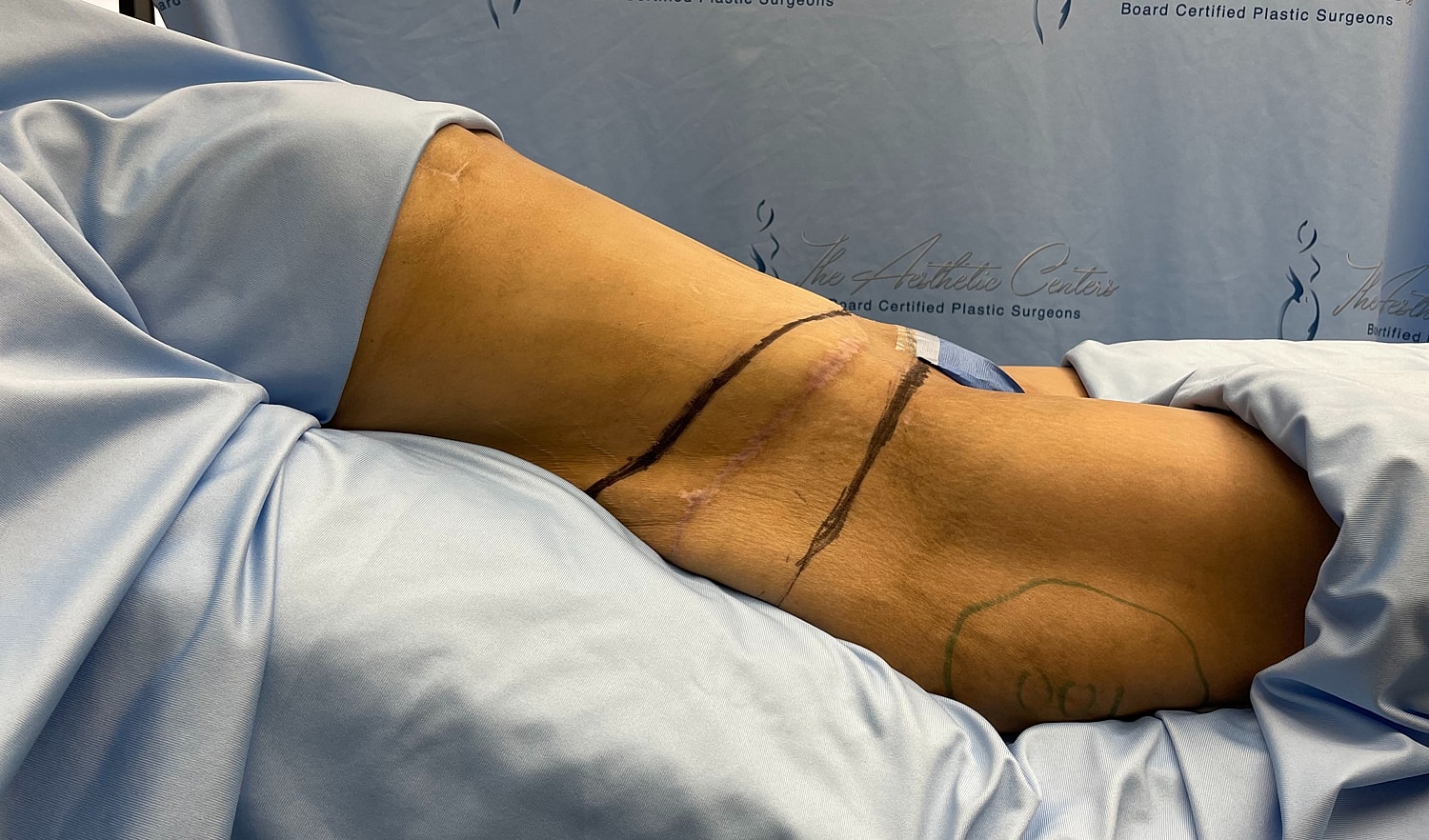 Post-surgery leg with markings and stitches visible.