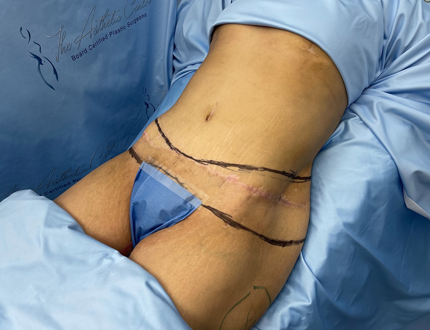Post-surgery abdomen with markings and dressings.