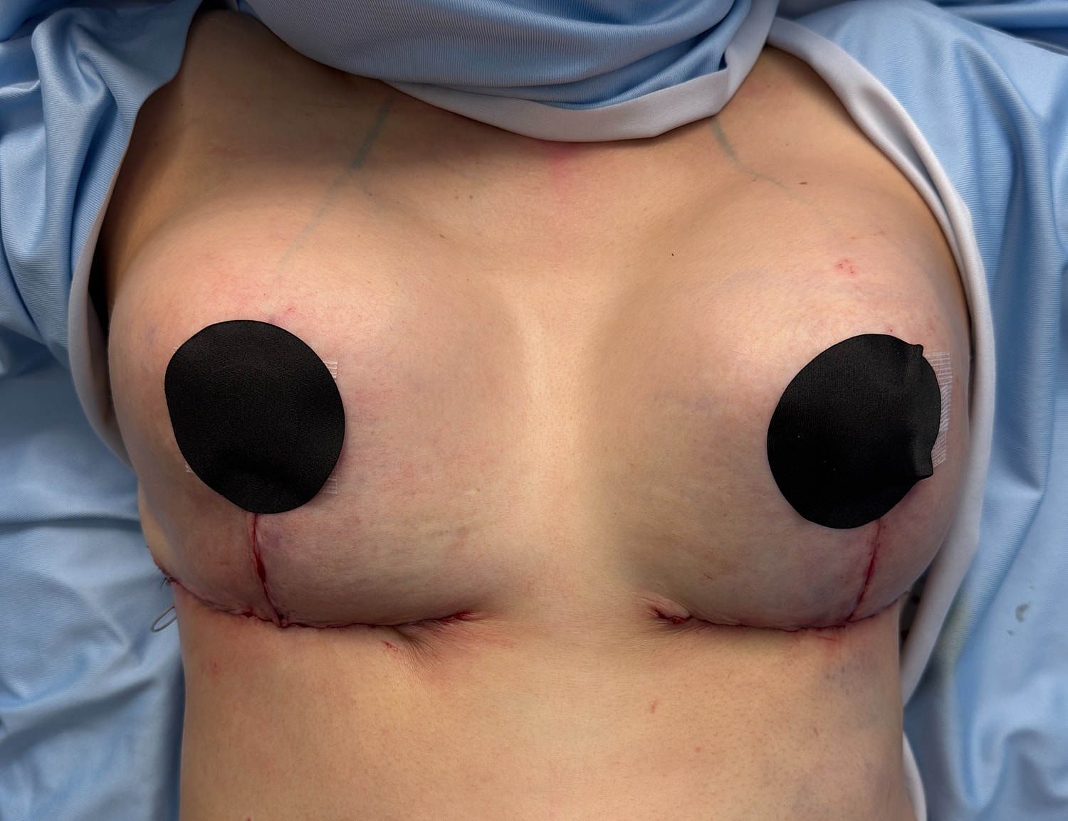 Post-surgery breast area with dressings applied.