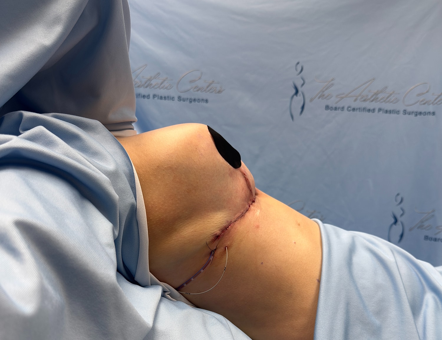 Post-surgery view with stitches on abdomen.