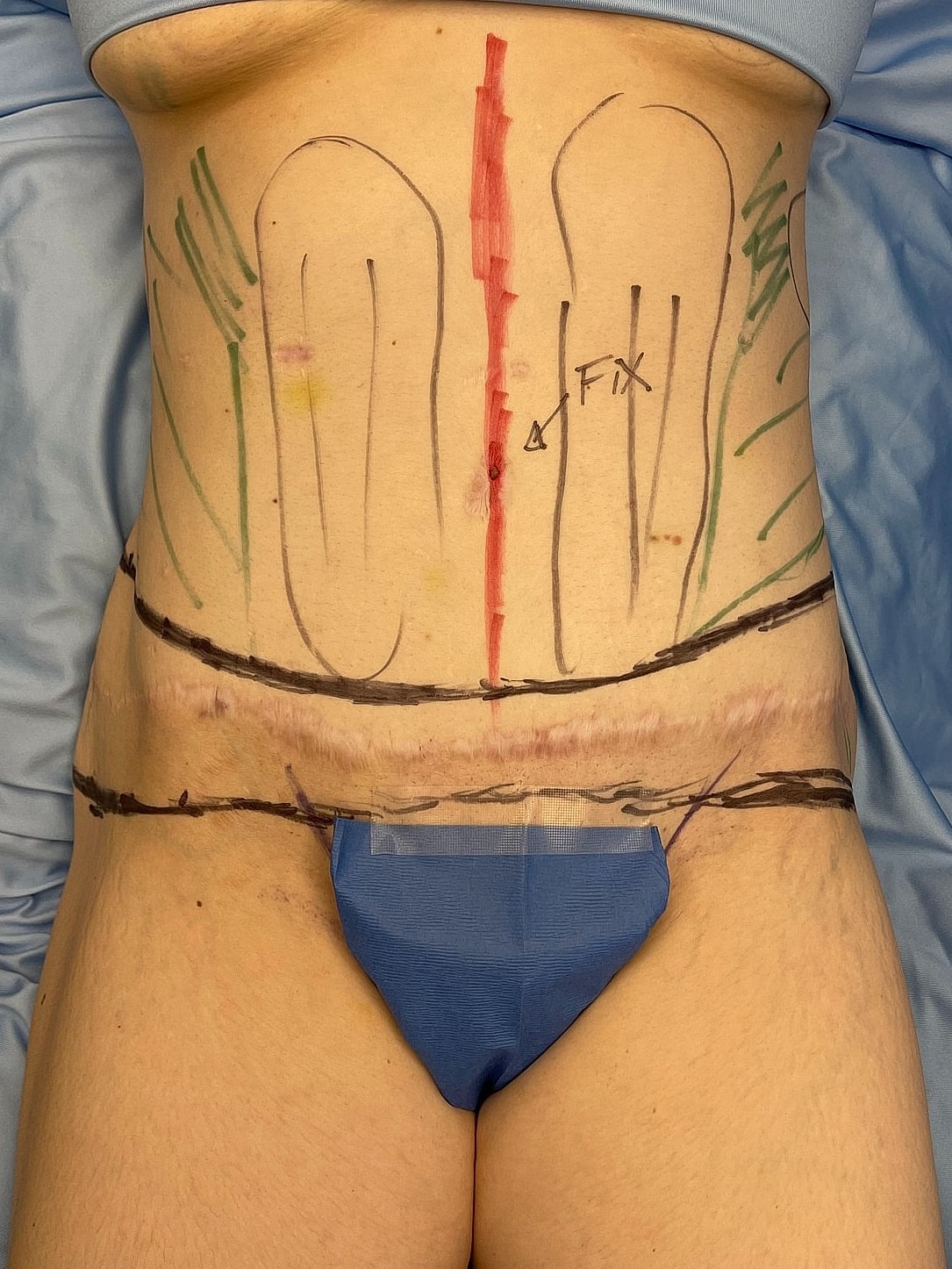 Body markings for surgical planning procedure.